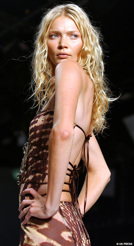 At 110 lbs and 6'2", model Jodie Kidd is medically underweight, by BMI.